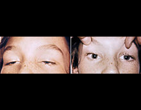 Ptosis - Eyes Alive