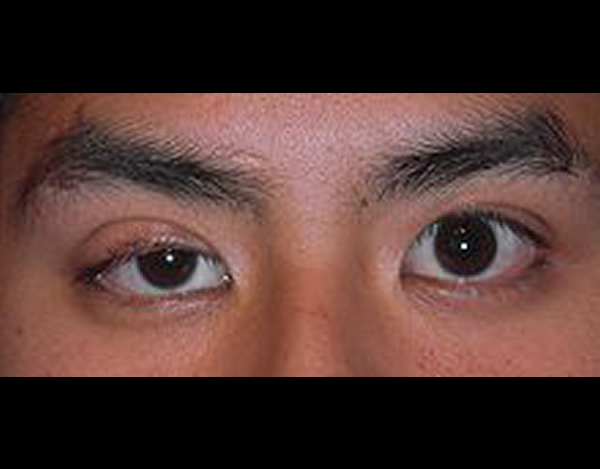 Ptosis - Eyes Alive