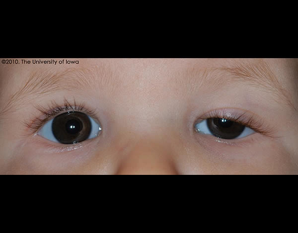 Ptosis - Eyes Alive
