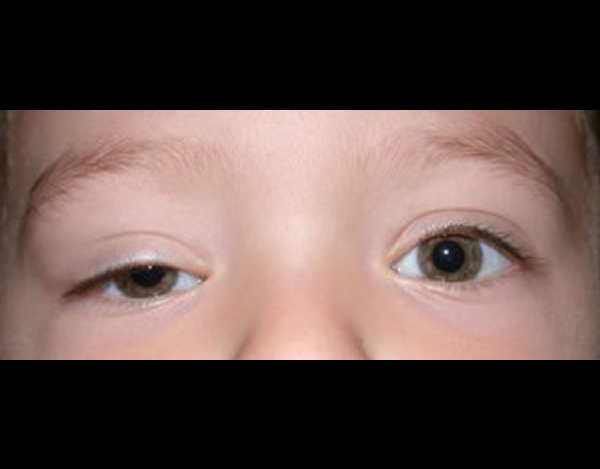 Ptosis - Eyes Alive