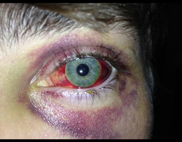 Ptosis - Eyes Alive