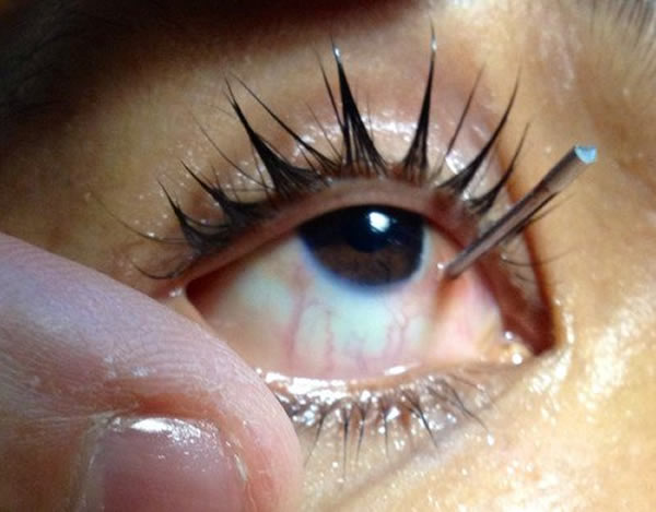 Ptosis - Eyes Alive